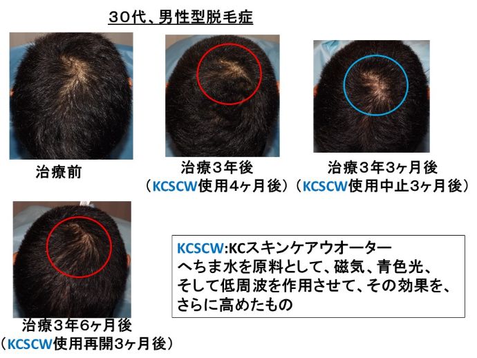 円形脱毛症　病院